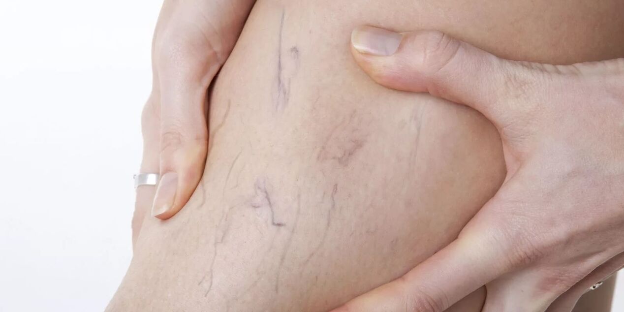 Before using the varicone cream