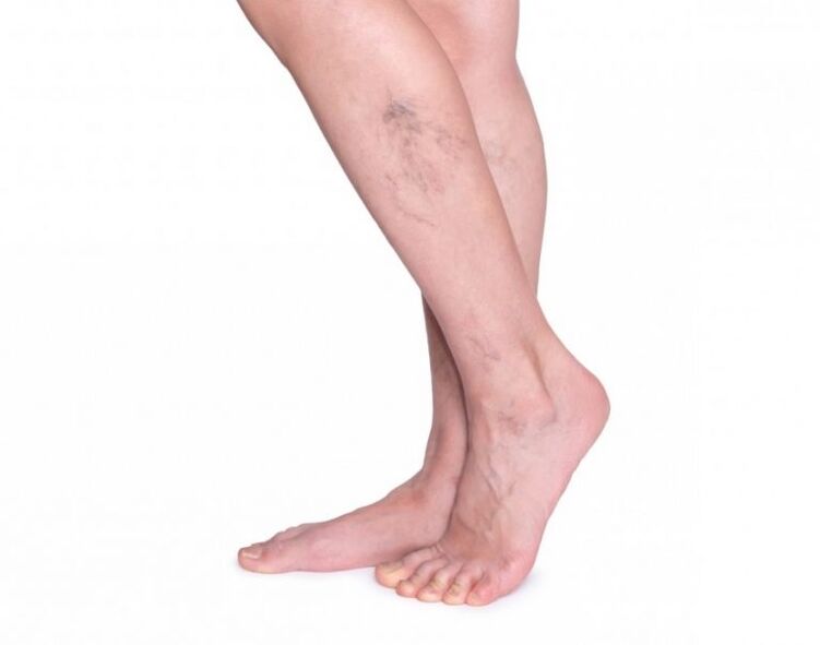 Varicose veins before chest treatment