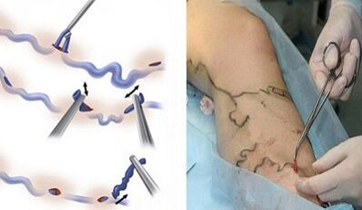 Flebectomy for varicose veins on tops