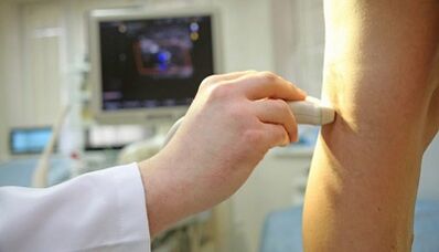 Laser treatment of varicose veins