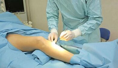 As the operation is carried out with varicose veins