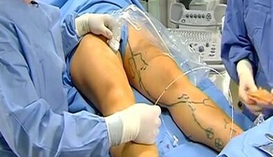 Work for varicose veins