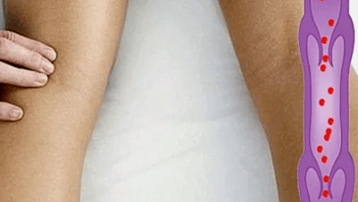 Reasons for the development of varicose veins of the lower extremities