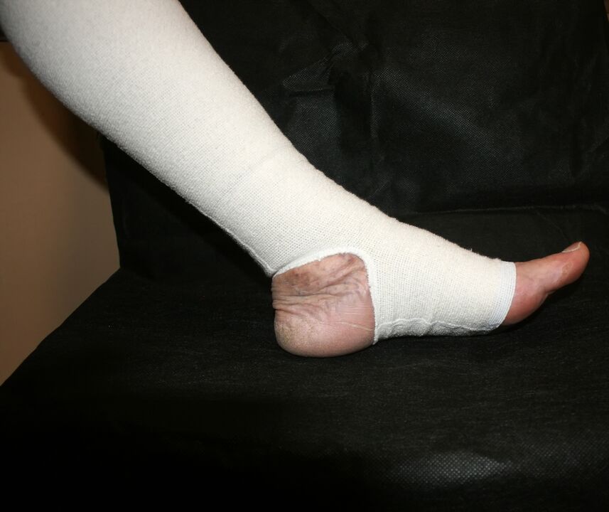 Compression knits for varicose veins